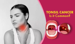 What is Tonsil Cancer?