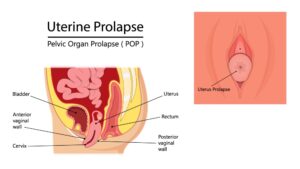 What is Uterine Prolapse?