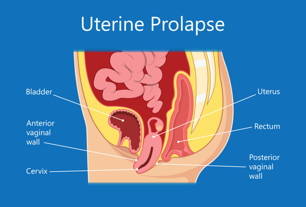 Uterine Prolapse