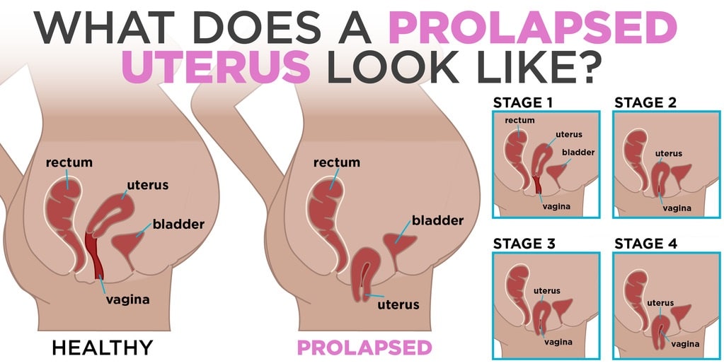 Stages of Uterine Prolapse