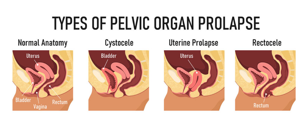 Type pf Pelvic Prolapse 