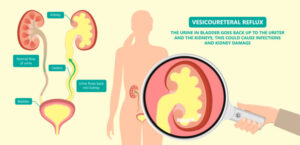 What is Vesicoureteral Reflux?