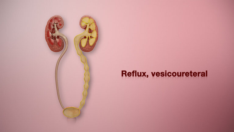 Vesicoureteral Reflux