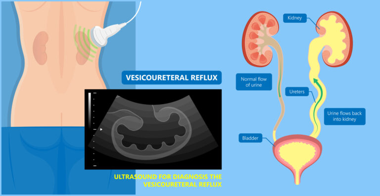 Vesicoureteral Reflux Diagnosis