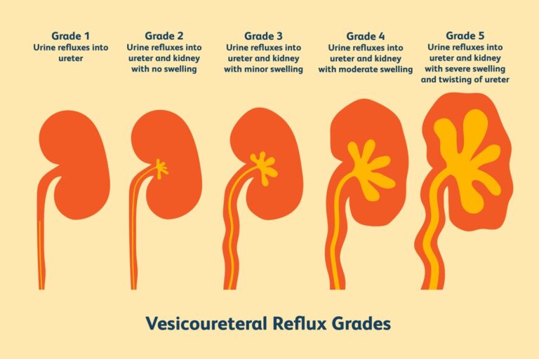 Grades of Vesicoureteral Reflux