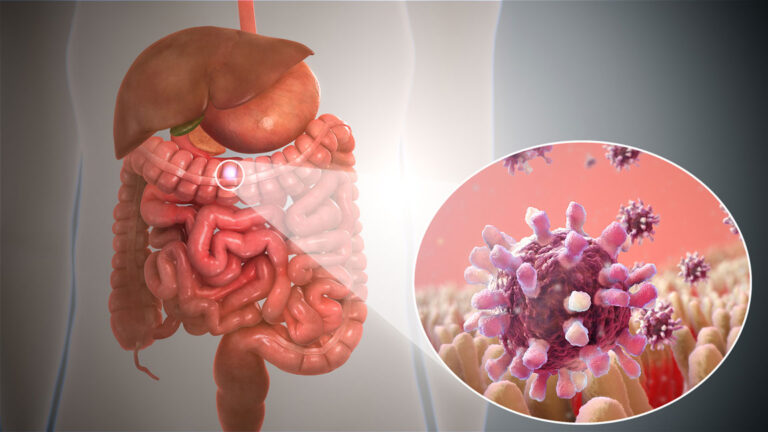 Viral Gastroenteritis