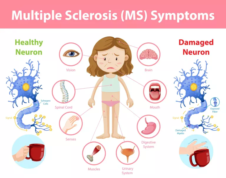 MS symptoms