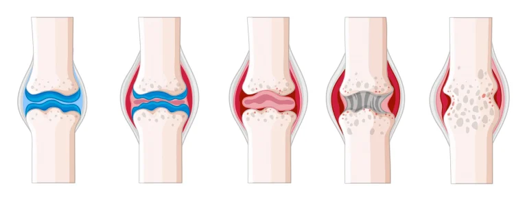 Rheumatoid arthritis