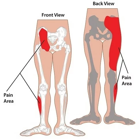 SI joint pain area