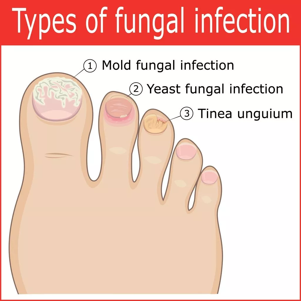 Types of foot fungus