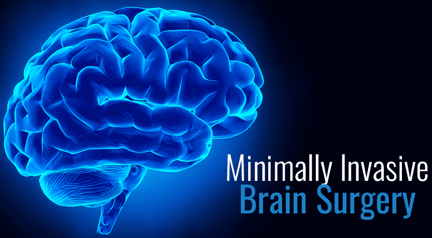 Minimally Invasive Brain Surgery