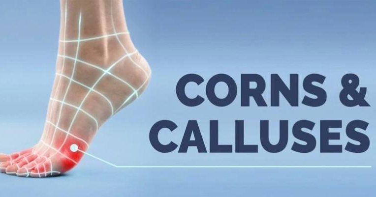 Corns and Calluses 