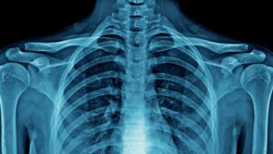 What is Costochondritis?