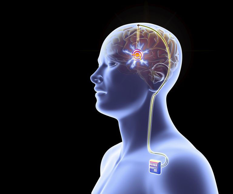 Deep Brain Stimulation for Depression