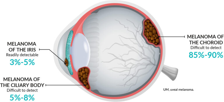 Ocular Melanoma