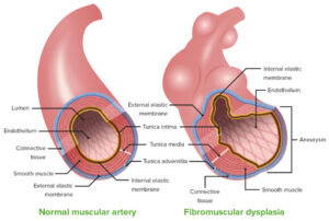 Fibromuscular Dysplasia