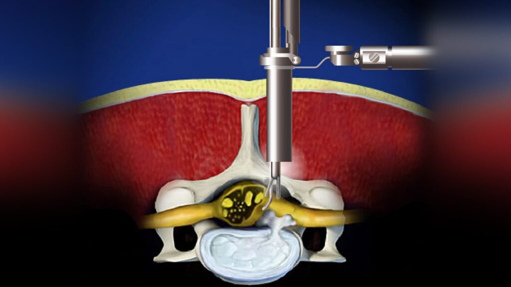 Foraminotomy Spine Surgery