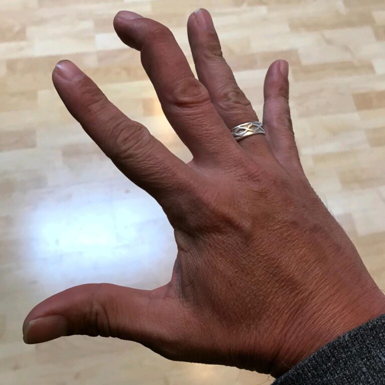 Hammer Finger: Baseball Finger