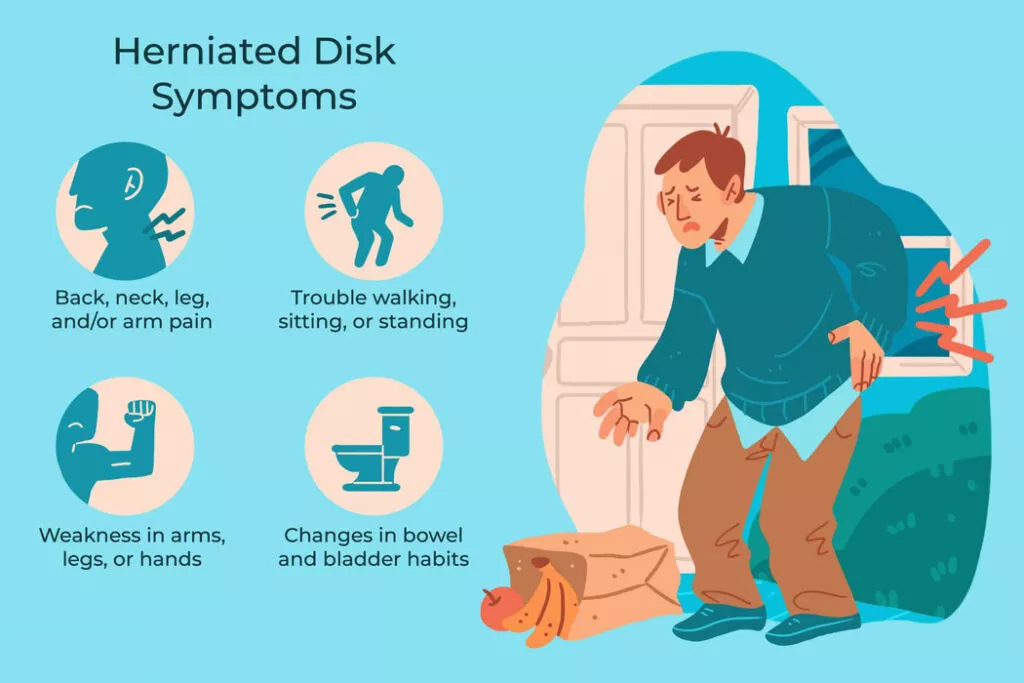 Symptoms of Herniated Disk