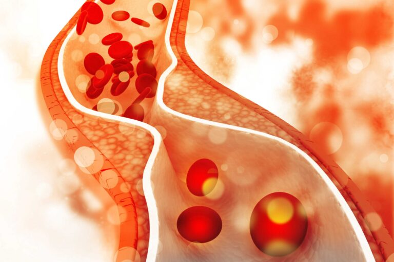 Hyperlipidemia