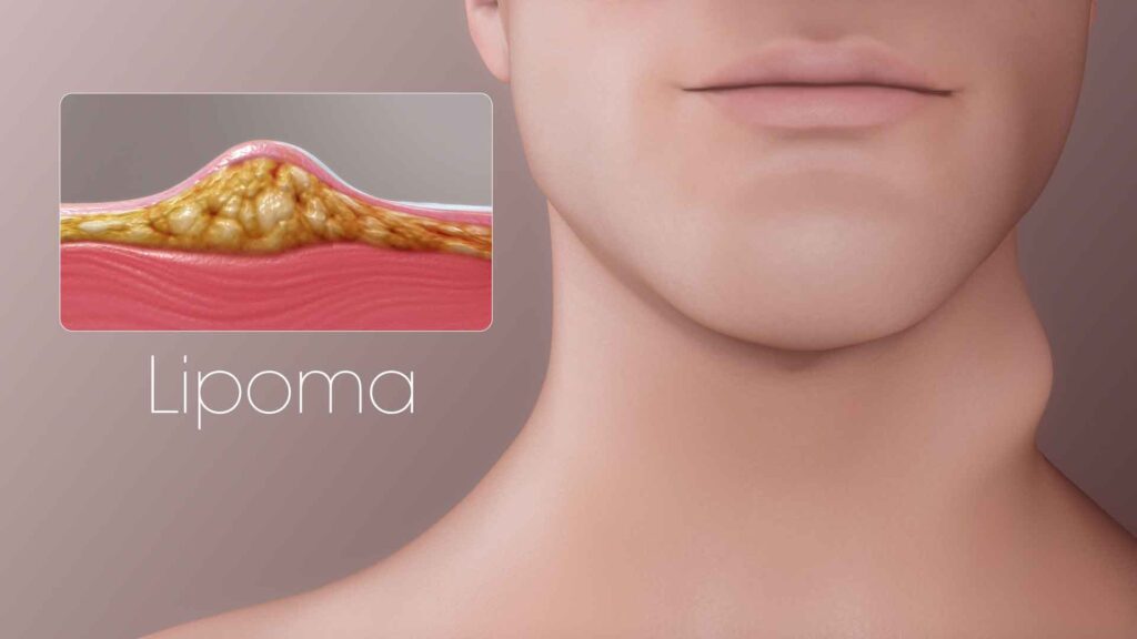 What is Lipoma?