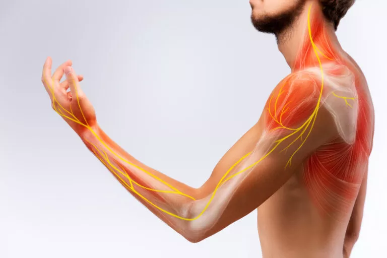 Nerve pain in your arms