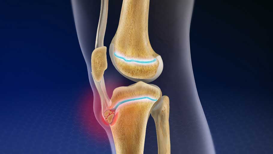 Osgood-Schlatter Disease: Causes, Symptoms, and Treatment