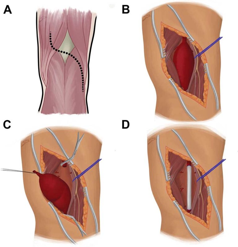 What is Popliteal Artery Aneurysm?