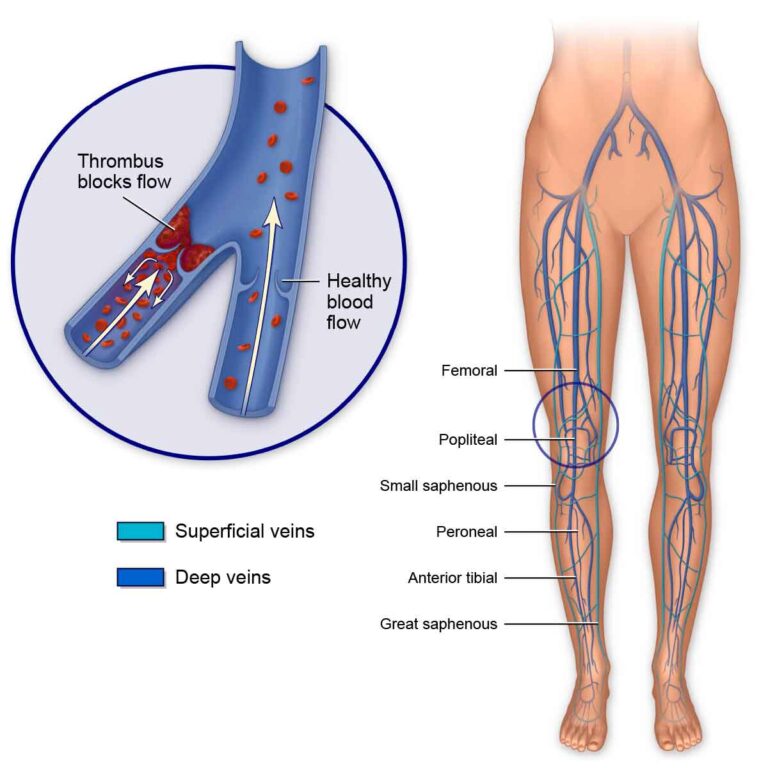 What is Popliteal Vein Thrombosis?