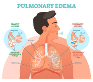 Pulmonary Edema