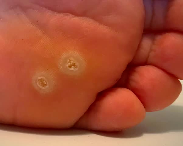 PLANTAR WARTS SYMPTOMS 