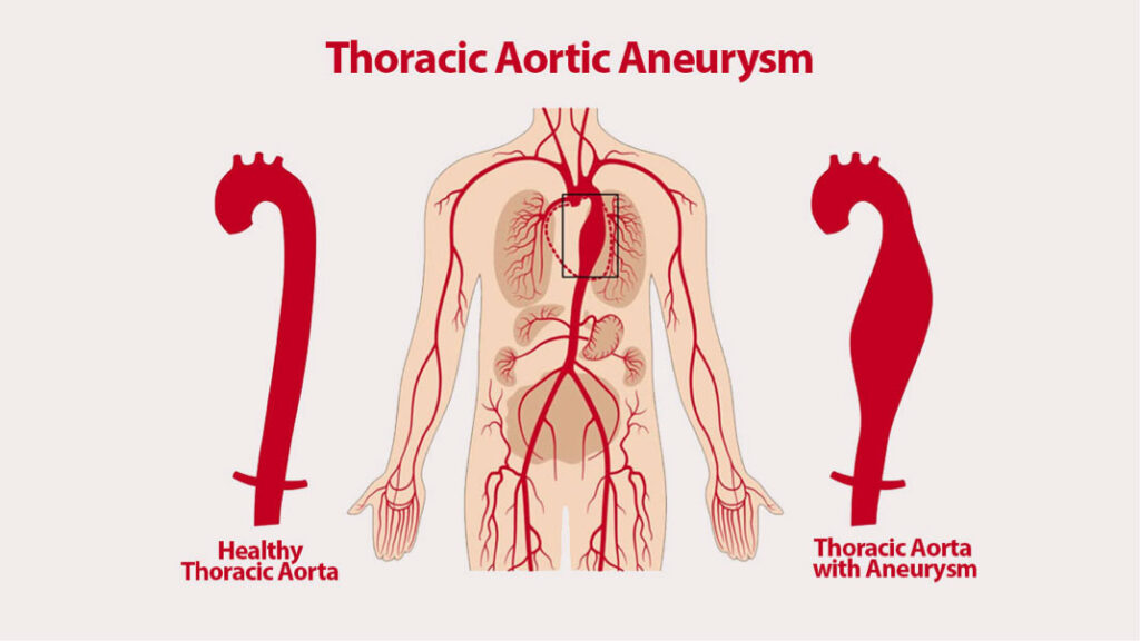 What is an Abdominal Aortic Aneurysm?