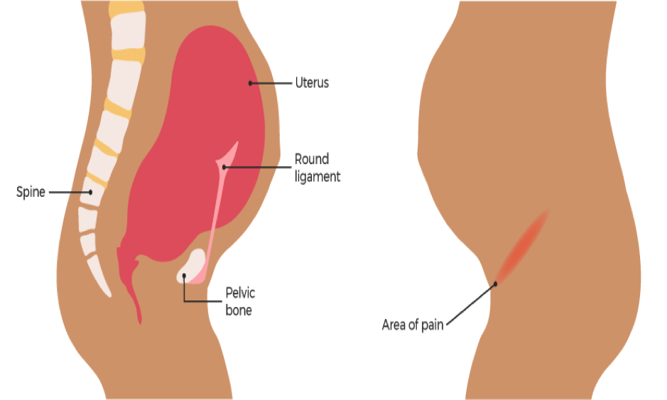 round ligament pain pregnancy