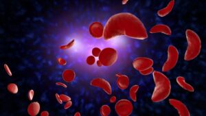 Sickle Cell Anemia