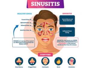 Chronic Sinusitis Treatment