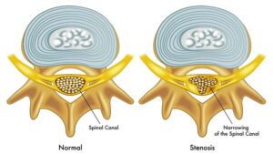 What is Spinal Stenosis?