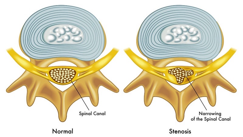 What is Spinal Stenosis?