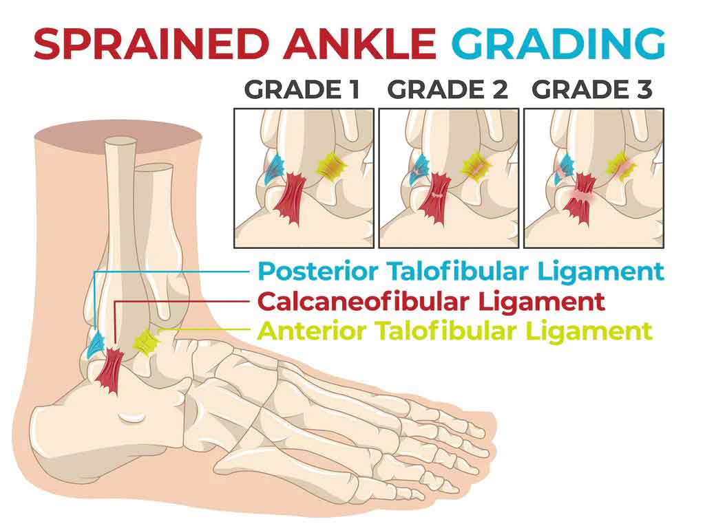 Grades of Sprains