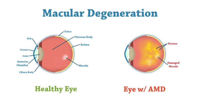 What is Wet Macular Degeneration?