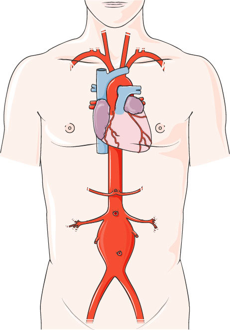 Abdominal Aortic Aneurysm Symptoms