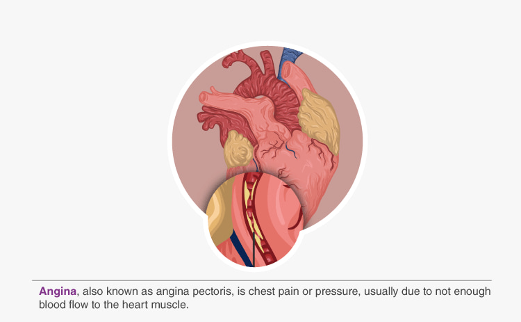 What is Angina?