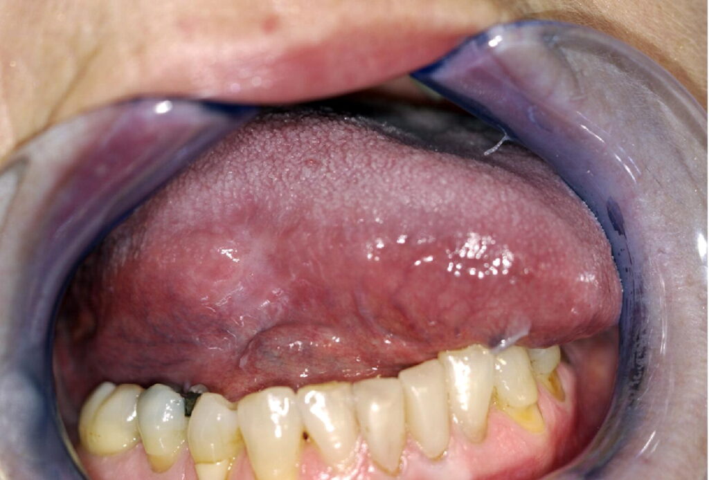 leukoplakia symptoms