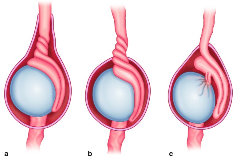 Testicular Torsion