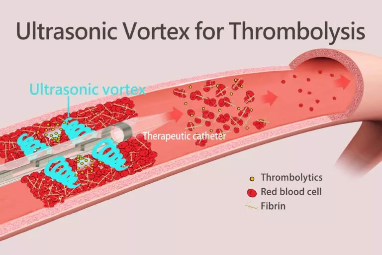 Thrombolysis Procedure