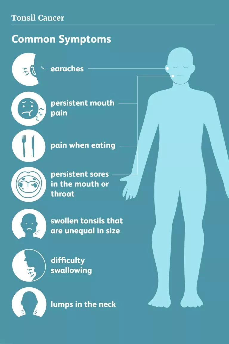 Tonsil Cancer Symptoms