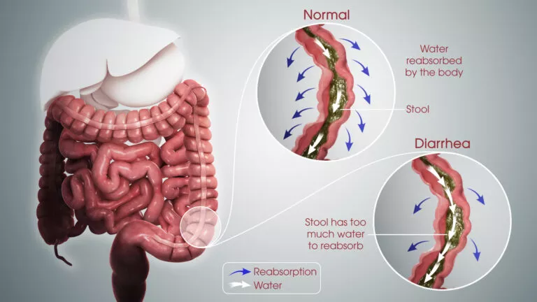 What is Diarrhea?