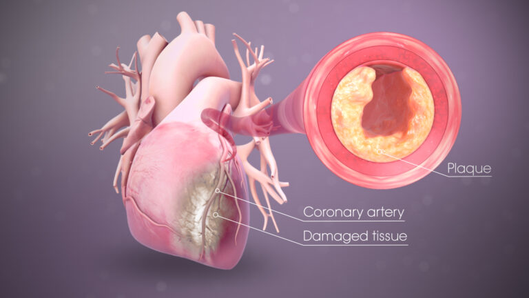 What is Myocardial Ischemia?