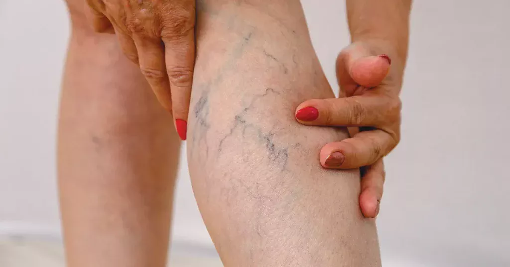 Varicose Veins