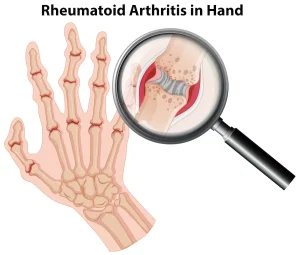 Rheumatoid arthritis in hand