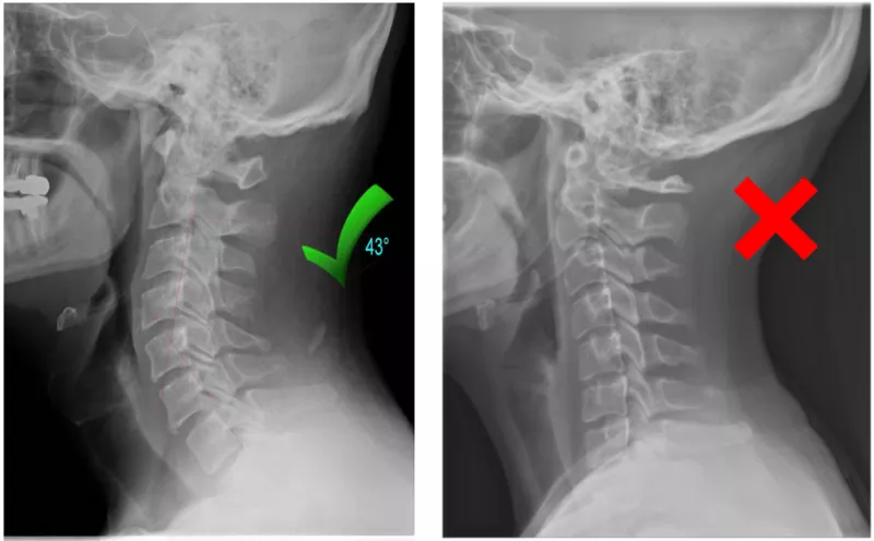 normal curvature of neck